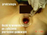 choroba hemoroidalna