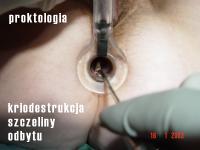 szczeliny odbytu